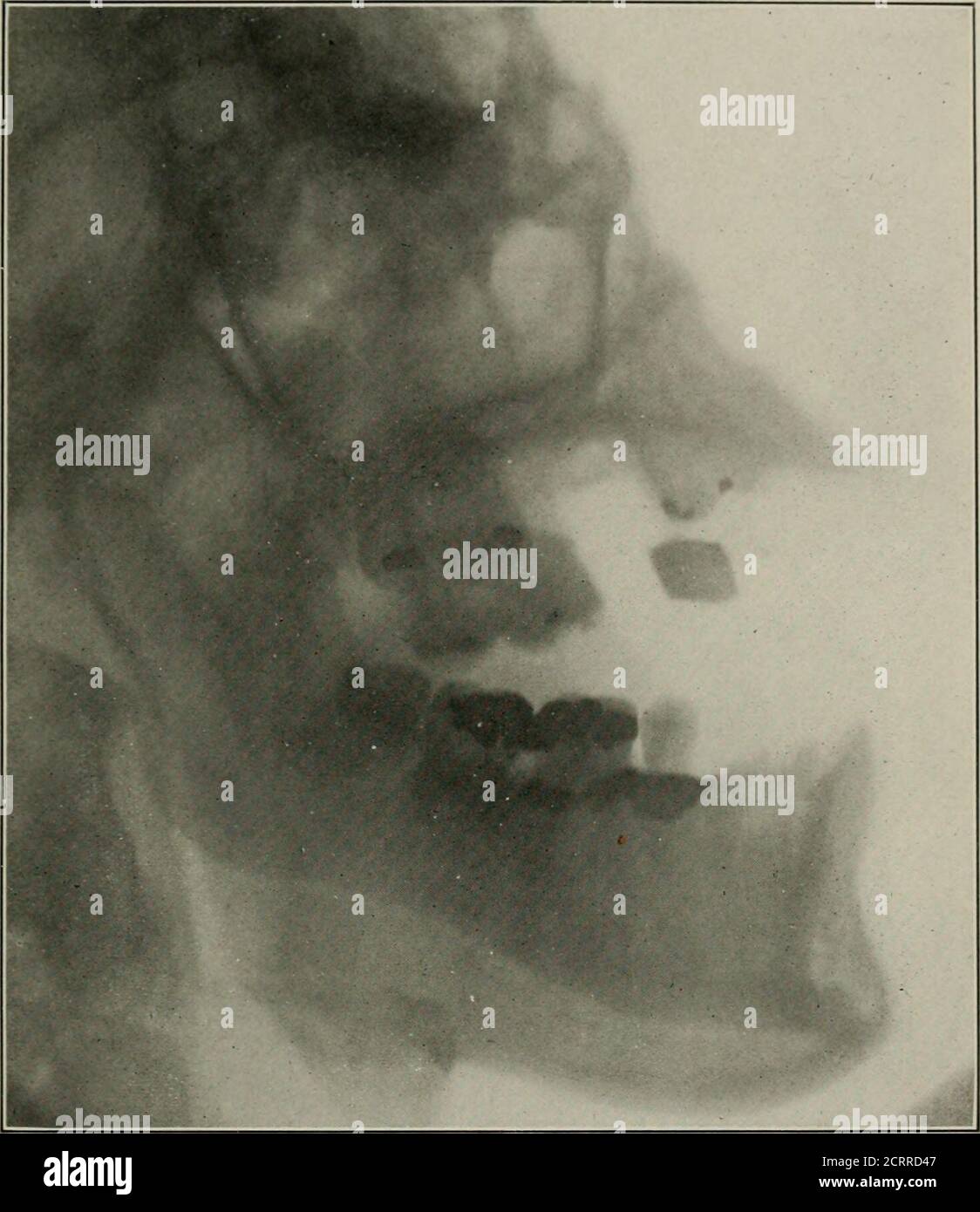 Elementary And Dental Radiography Fig 877 The Arrows Point To A Piece Of Tooth Root In The Antrum Of St Louis Radiograph By Carman First Molar Was Extracted An Opening Made Elementary And Dental Radiography Fig 877 The Arrows Point To A Piece Of Tooth Root In The Antrum Of St Louis Radiograph By Carman First Molar Was Extracted An Opening Made