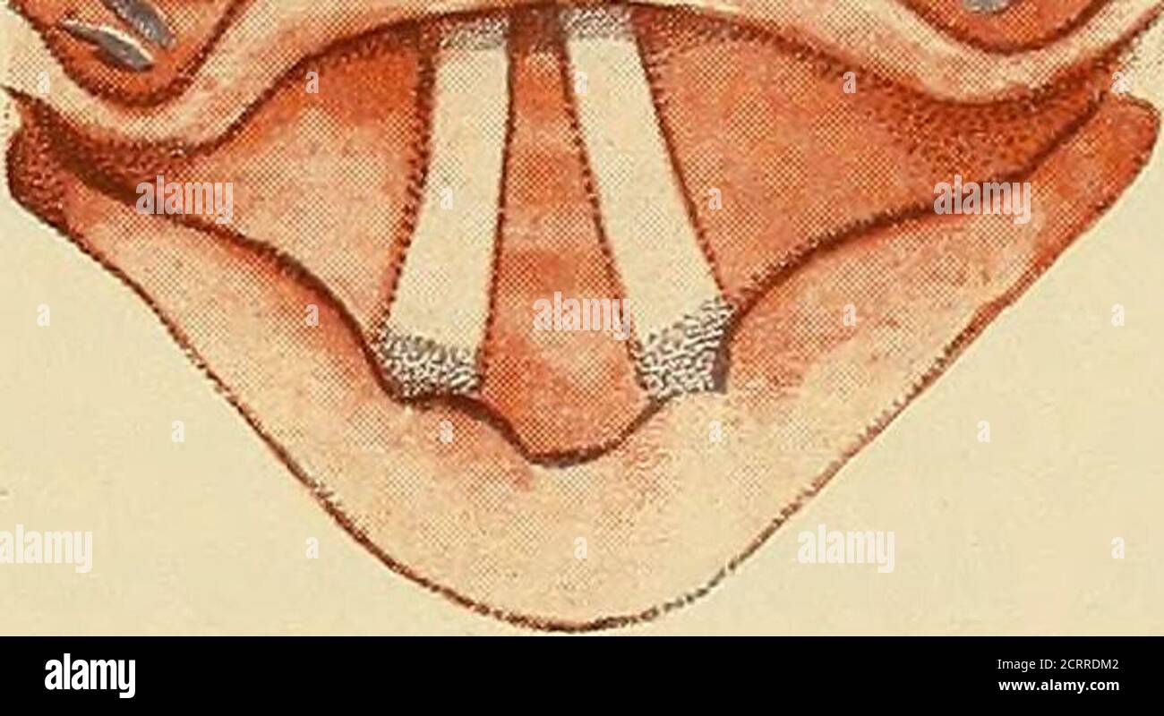 Diseases of the nose and throat . Fig. 87ft.—Bilateral hypertrophy of  lingual tonsil.(Authors specimen.) patient. The condition may be either  unilateral or bilateral (Figs.87 and 87a). Pathology.—This mass of glands  extends
