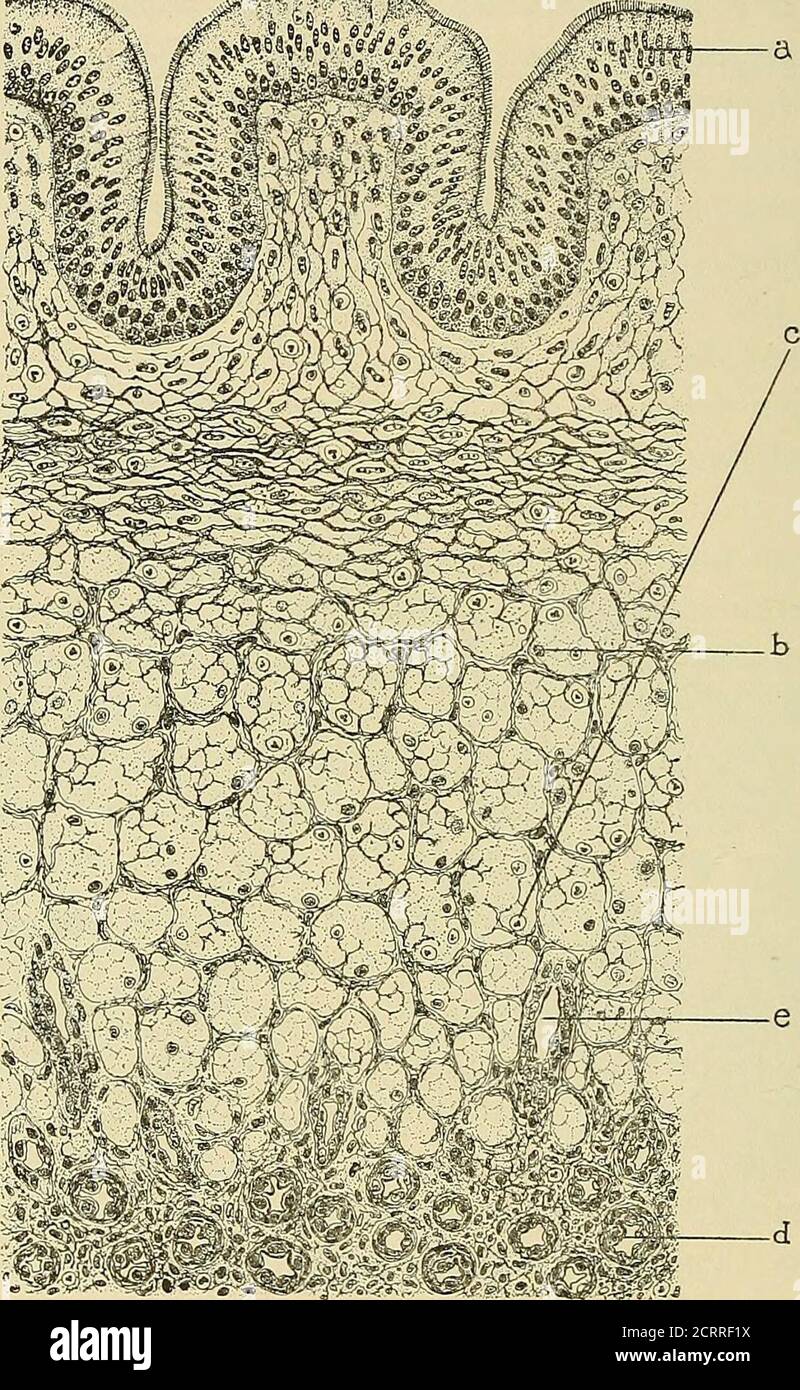 . Diseases of the nose and throat . may be mixed in character,or either squamous or ciliated, according to circumstances and situa-tion. Within this there is hypertrophy of the structural elementsof the mucous membrane and connective tissue, giving a fine reticularframe-work, the meshes of which are filled with semifluid mucinand leucocytes. Glandular tissue may be present, but there is usuallya minimum of vascular elements (Fig. 62). The site of attachment is usually the internal surface of themiddle turbinated. It may be around the margin of the ostiummaxillare or along the whole of the lowe Stock Photo