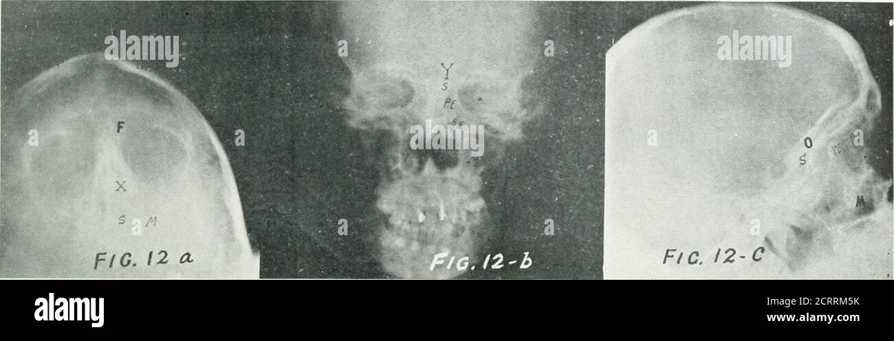 . Archives of physical medicine and rehabilitation . boundary Hue between the anteriorand posterior ethmoid cells. S, sphenoid sinus. P,posterior ethmoid cells. A, anterior ethmoid cells.M, maxillary slnns, F, frontal sinus. no A NEW TECHNIQUE FOR SPHENOID SINUS AND ETHMOID CELLS—GRANGER In cases of glioma or other tumor ofthe base of the brain in the region ofthe optic groove, besides the changesusually seen in the anterior clinoidprocess in the lateral view, the 107angle view should show definite alter-ations of the curved sphenoid line. In cases of neoplasm of the sphenoidsinus, besides the Stock Photo