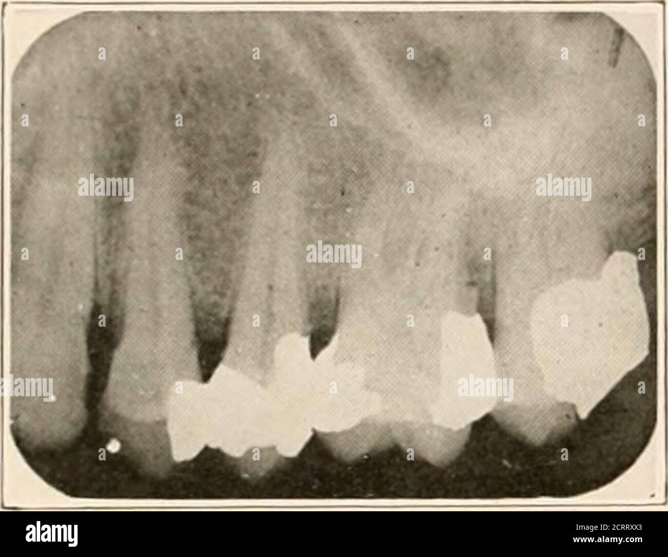 . Dental and oral radiography : a textbook for students and practitioners of dentistry . radiograms must understand enough of the funda-mental rides of radiographic technic to know when ex-amining a radiogram, whether or not the technic in-volved in its making ivas correct or faulty, and if faulty,whether or not the degree of fault is sufficient to renderit so inaccurate as to be useless. L24 DENTAL AM) ORAL RADIOGRAPHY Iii correctly made radiograms, the denial and oralstructures under normal conditions have a characteristicappearance, for, owing to the varying densities of thecontained struct Stock Photo