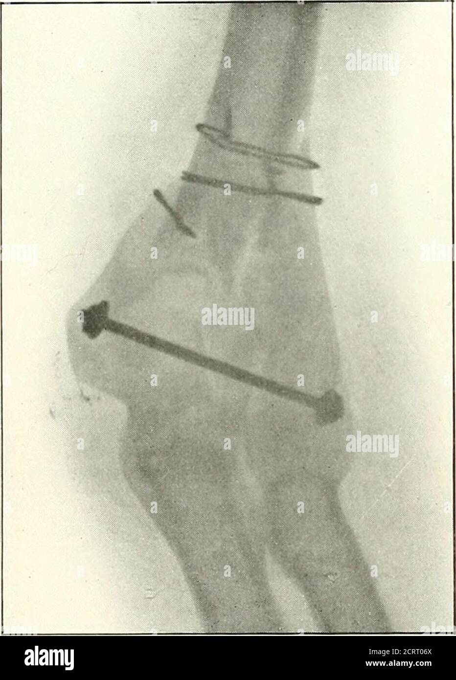Transverse Incisions High Resolution Stock Photography and Images - Alamy