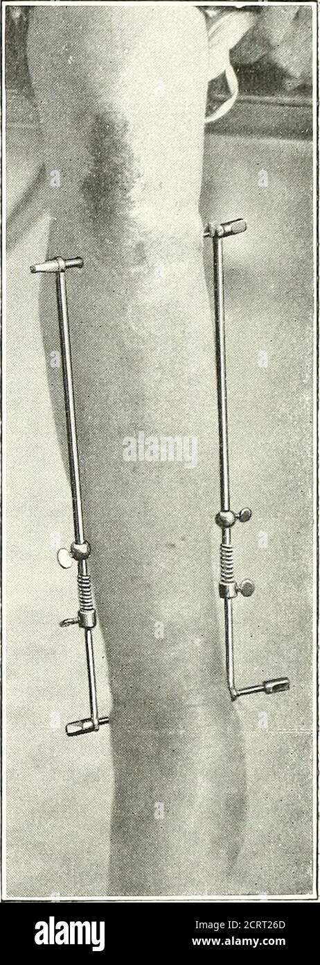 . On modern methods of treating fractures . Fkj. .{S.—A complicated suiaramalleolarfracture before treatment. Fiif. 39.—The leg shown in Figs.38 and 40, with the double trans-fixion apparatus (earlyj/pattern)applied. one and a half inches abo^e the epieondyles, in front of theinternal epicondylar ridge and behind the outer. In this wayboth the ulnar and musculospiral neres will be avoided, ai The metal hoop which surrounds the loAver end of the arm MECHANICAL MODIFICATIONS OF ENTENSION METHOD ^81 is shaped so as to be above the forearm when the latter isflexed. Application to the Femur.— The Stock Photo