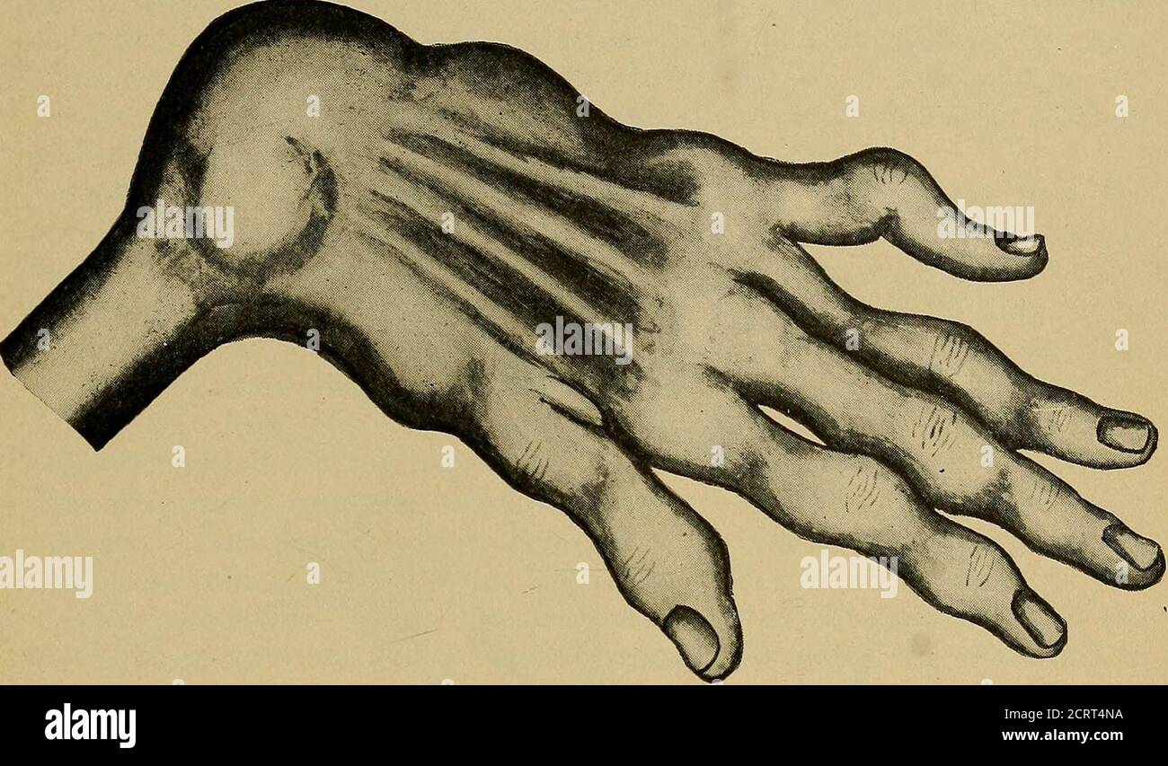 . A practical treatise on medical diagnosis for students and physicians . W Pseudomuscular atrophy. Claw-hand. (Gray.) so-called strumous persons, and the effeminate hand of one who is inclinedto tuberculosis, present sharp contrasts. Then, too, the occupation hand indicates in a general way the disease the patient is liable to—nonemore striking than the hand of the miner, the blue-black dottings of THE HANDS.- 197 which clearly indicate the possibility of anthracosis. Finally, we notethe broad hand and clubbed fingers that are seen in congenital heartdisease. The withered hand of age and wast Stock Photo