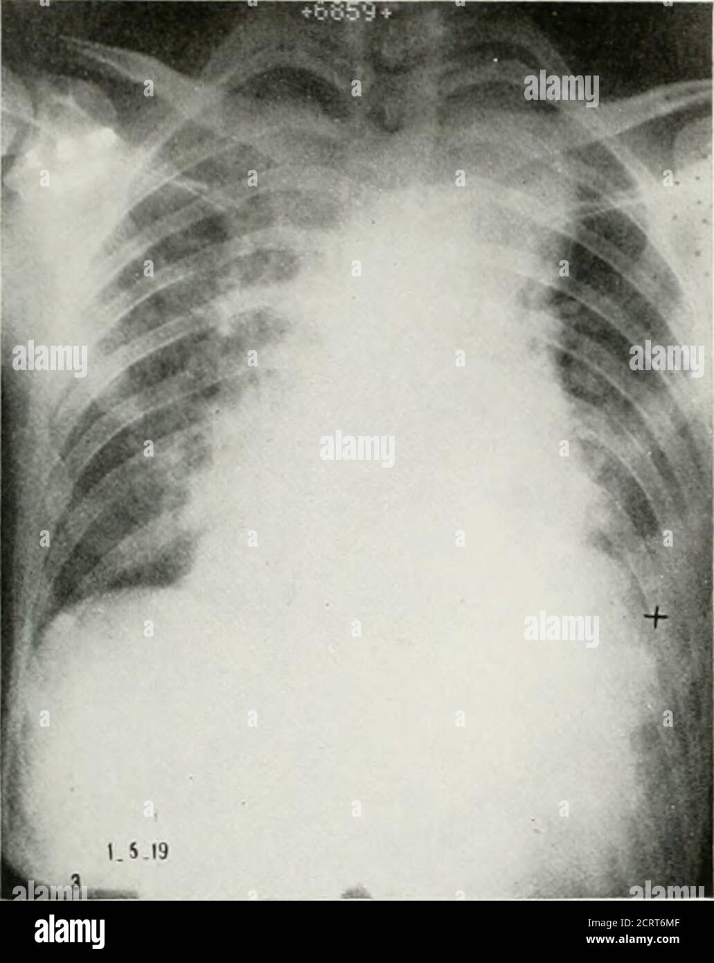 . The American journal of roentgenology, radium therapy and nuclear medicine . Fig. I. Shows hcmnrrhagic pneumonitis of lower right,diffuse mottling of upper and middle right lobes, dif-fuse mottling of lower and slight mottling of upperleft lobe. Costophrenic angle on left is obscured.Mediastinal glands are enlarged. Arrow points to areaof abnormal density in mediastinum, which subsequentfilms prove was a developing mediastinal abscess. IJ-29-18 Fig. 2. The armu pMiiis to the large mediastinal ab-scess. The cross mdicates the presence of empyema ofthe lower left che.sl. The heart silhouette i Stock Photo