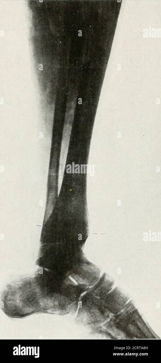 Ruptured vein hi-res stock photography and images - Alamy