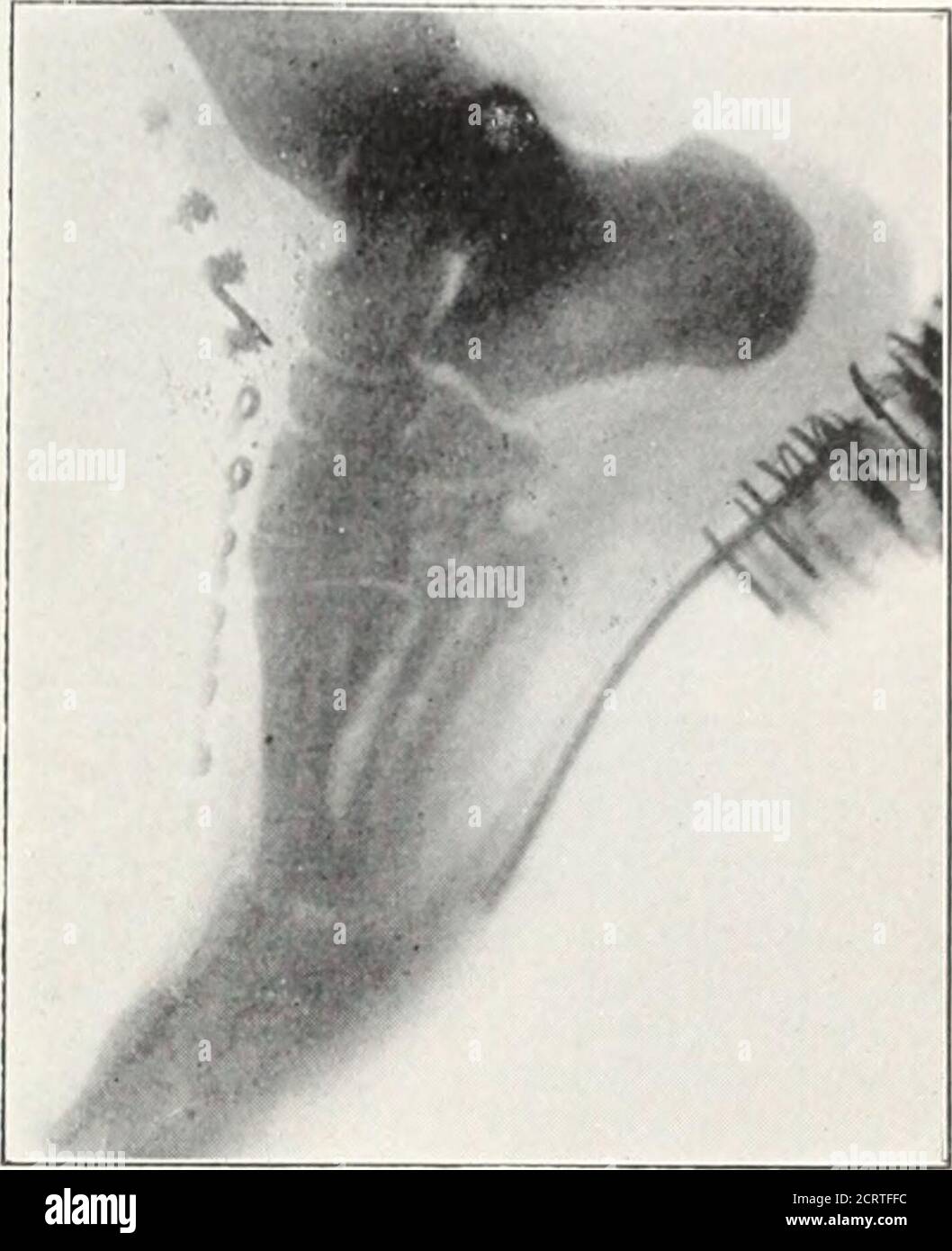 . American X-ray journal . This radiograph shows the right elbow«»f an ...
