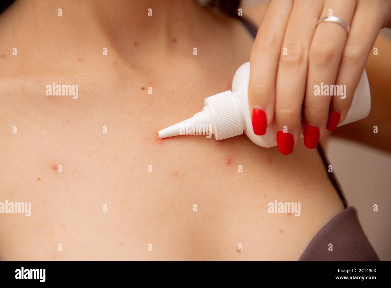 Close up woman applying cream on skin ill with chickenpox Stock Photo