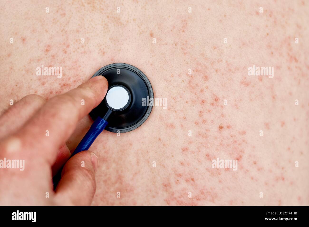 Allergic rash on the skin. Woman with dermatology problem on back skin ...