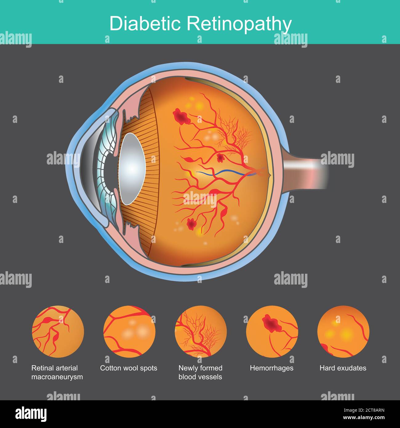 Diabetic Retinopathy. Illustration abnormality the retina from symptoms the diabetic retinopathy. Stock Vector