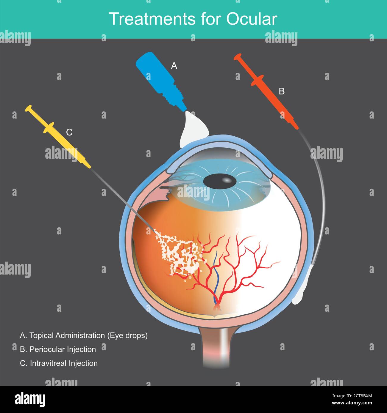 Treatments for Ocular. Illustration explain treatment of retinal diseases caused by blood vessel abnormal of the eye. Stock Vector