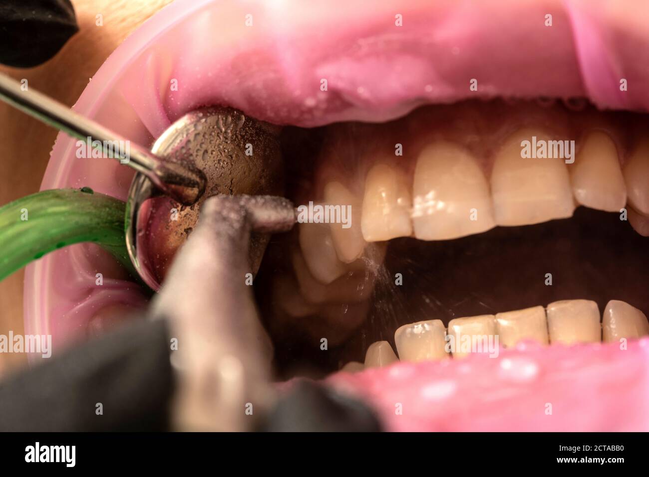 Closeup of teeth sandblasting, tartar cleaning and whitening Stock