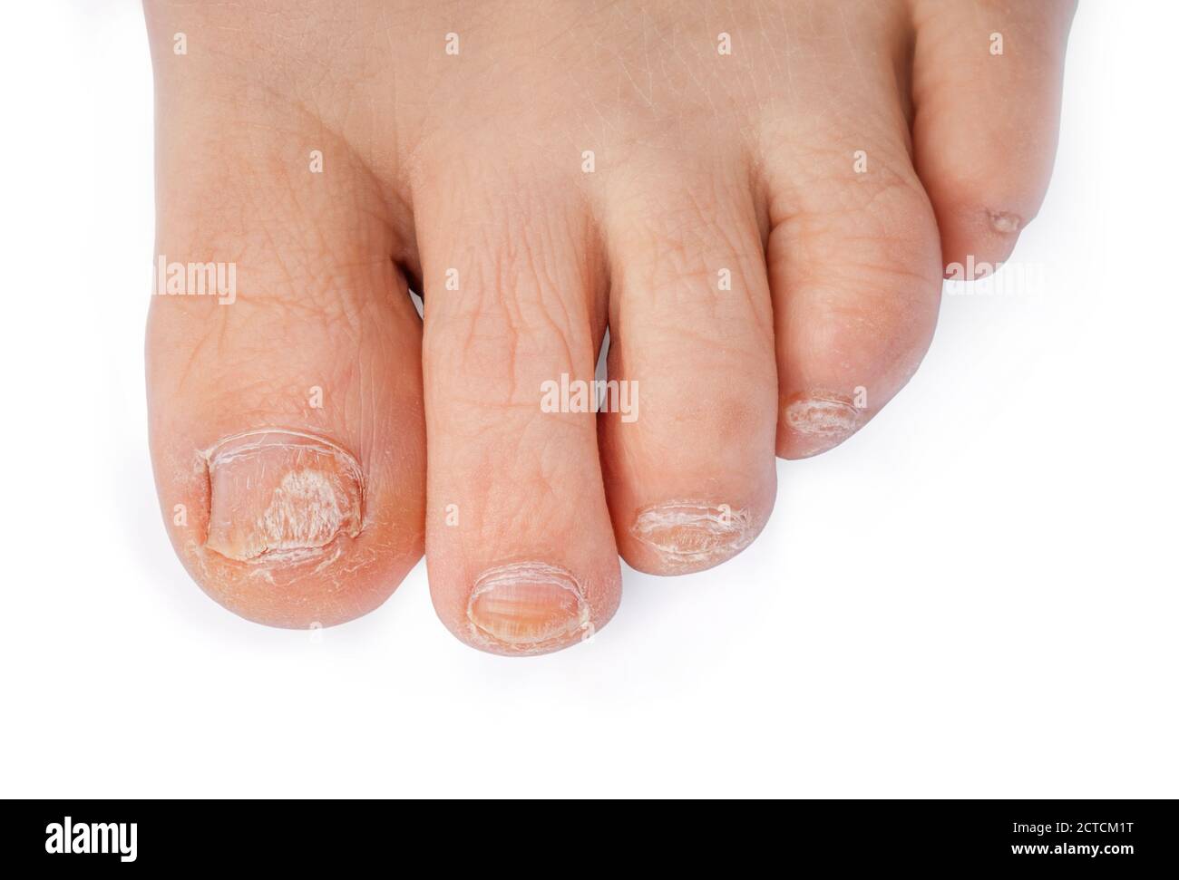 Toenail fungus infection. Partial foot close up.  All toenails are milky yellow discolored, oddly shaped and deformed and cracked (Onycholysis). Isola Stock Photo