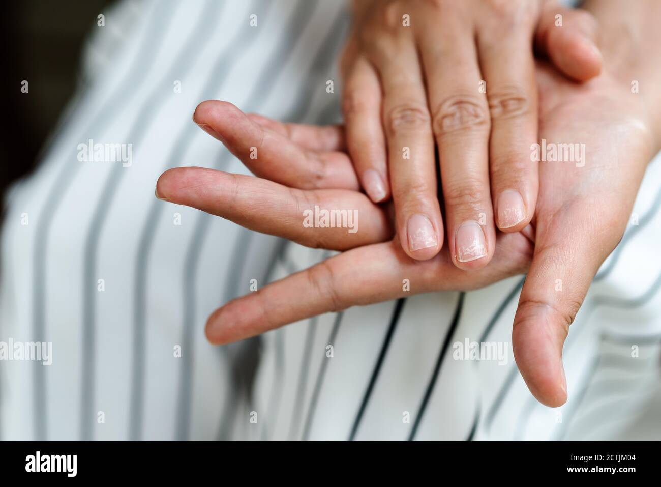brittle damaged nails after using shellac or gellacquer Stock Photo
