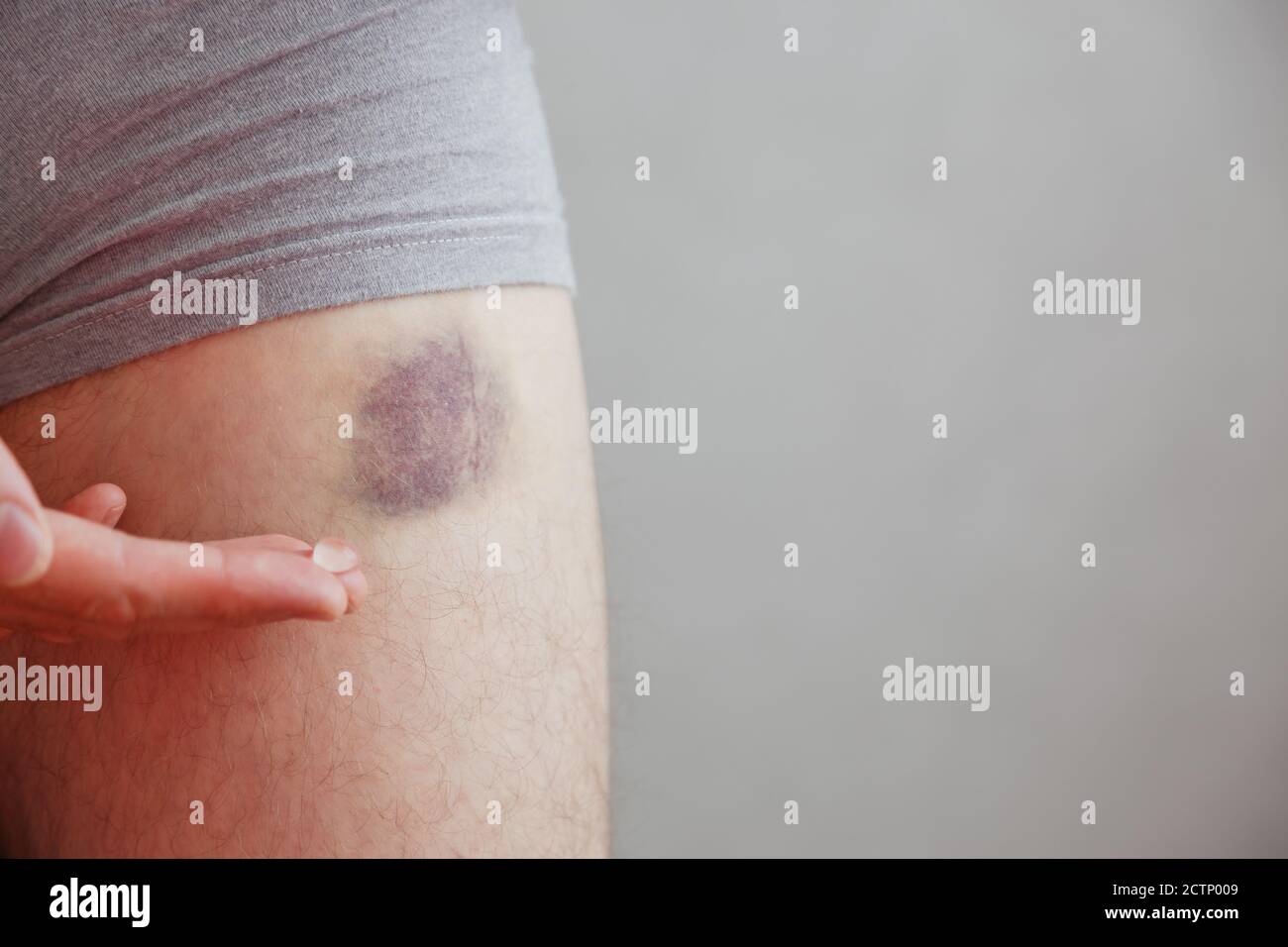 Man applies the healing gel to the bruise. Bruise on leg Stock Photo