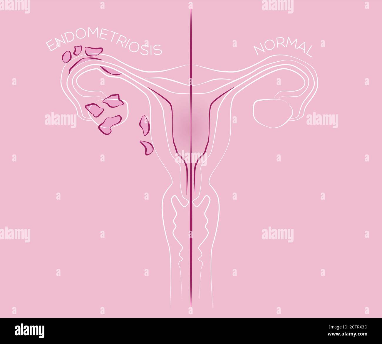 Endometriosis hires stock photography and images Alamy