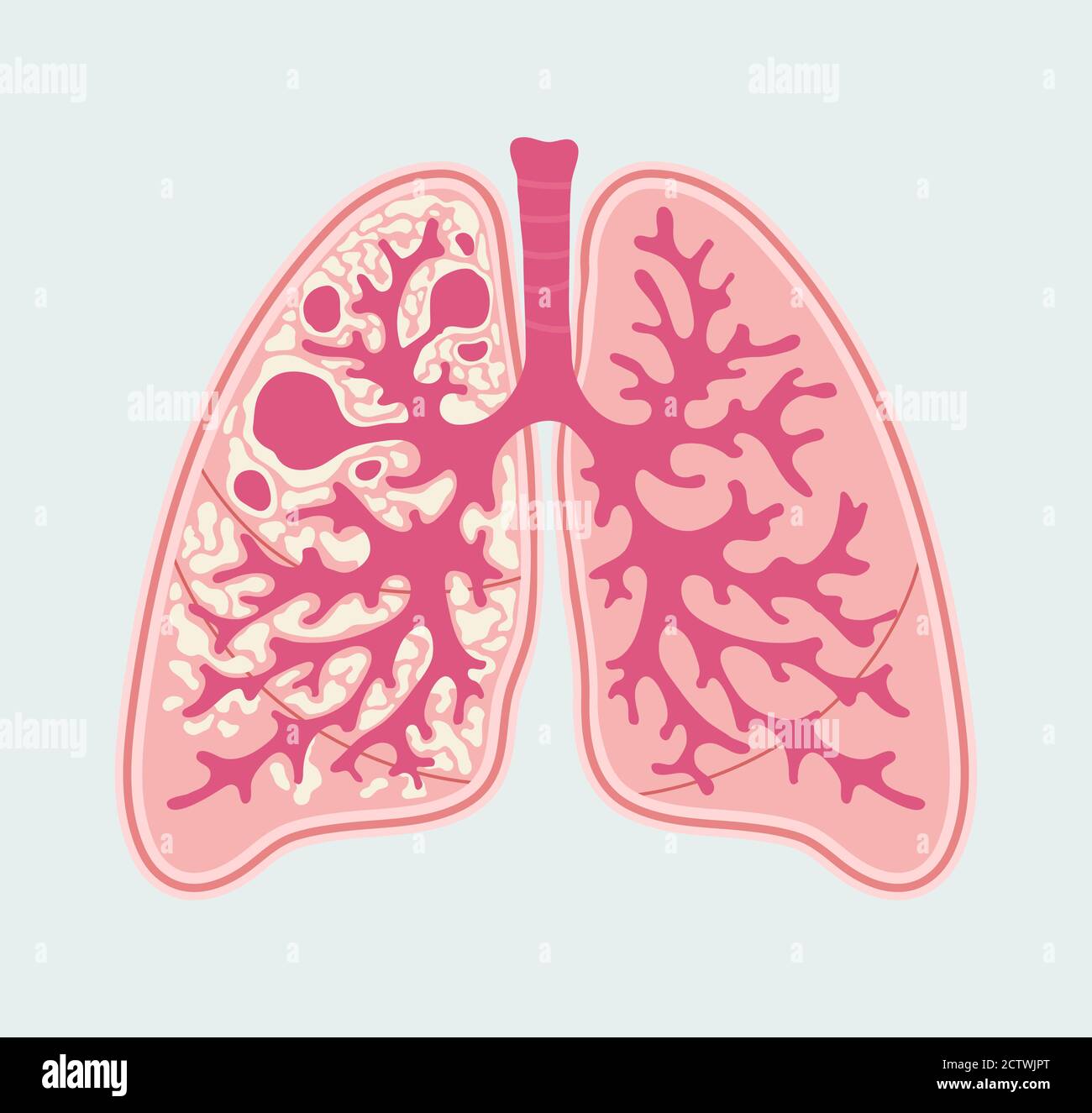 Patient-friendly scheme of TB damages in human lung. Anatomical Diagram of Tuberculosis. Respiratory system diseases Stock Vector