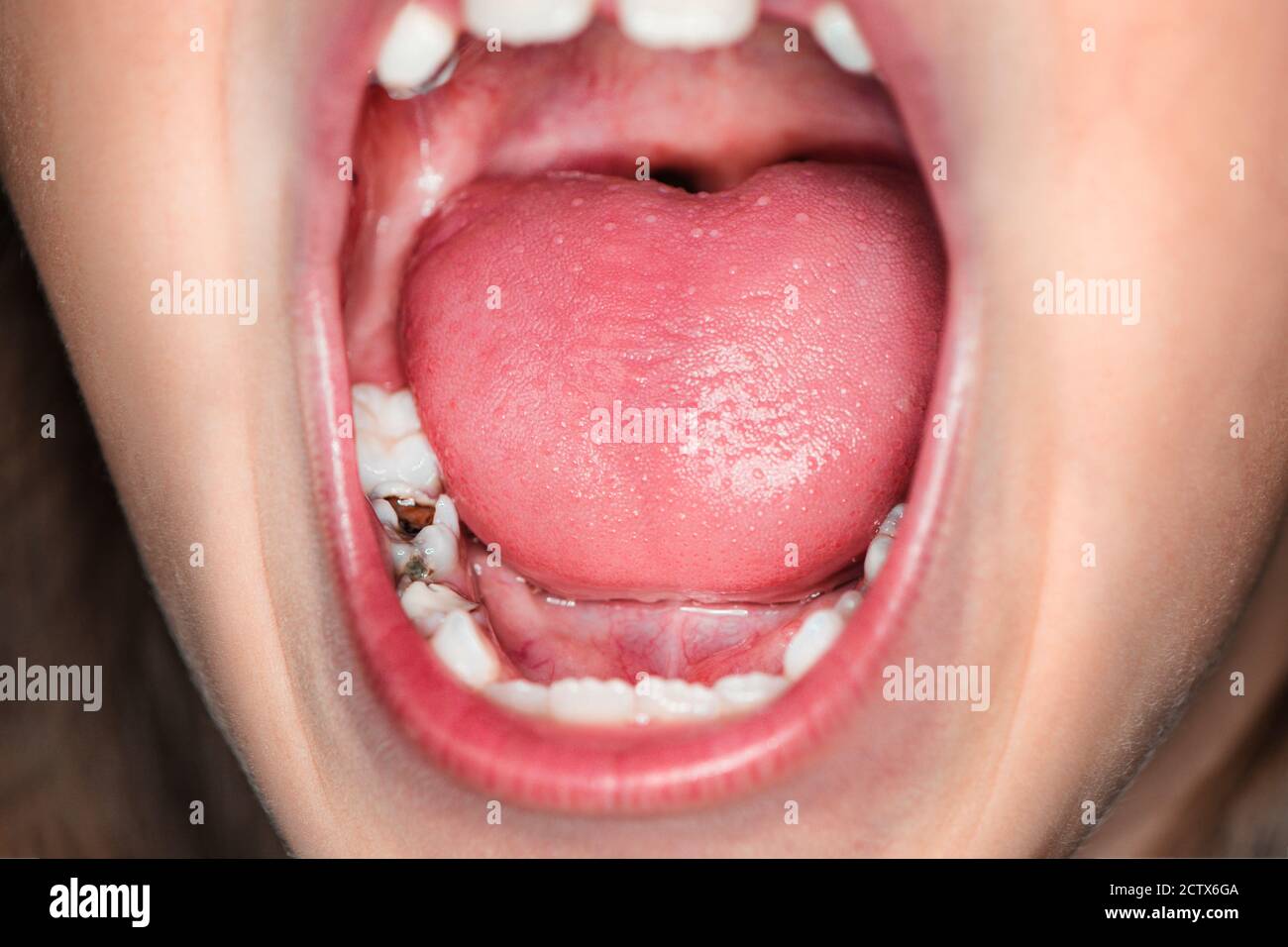 young girl screams from a toothache. Dental problems in children. Early