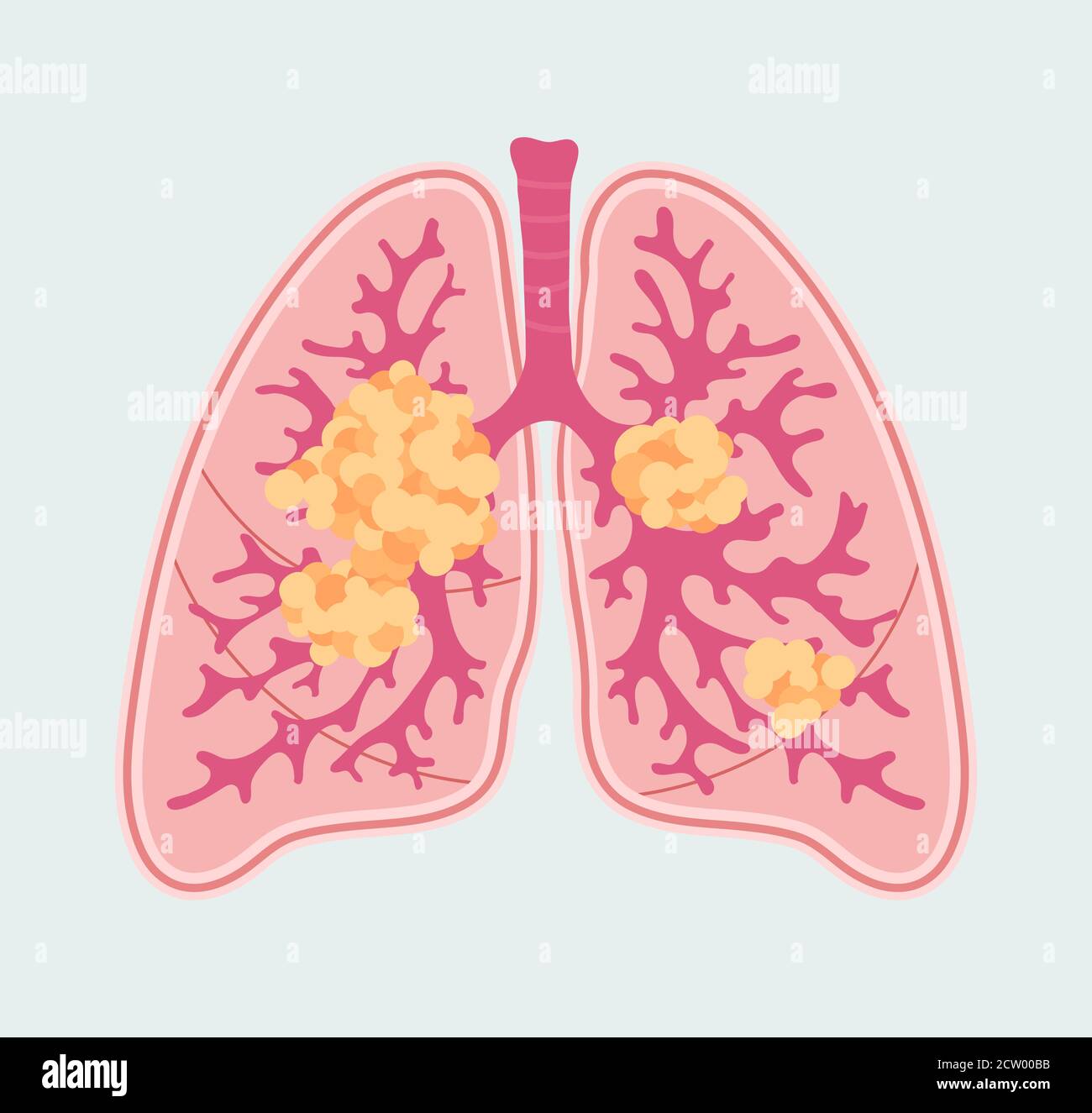 Patient-friendly scheme of Lung Cancer. Anatomical Diagram of tumor and metastasis in respiratory organs Stock Vector