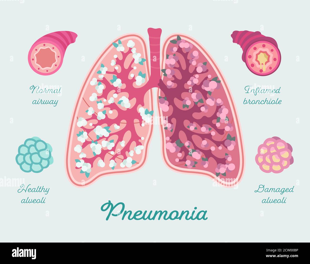 Pneumonia in human lungs. Inflammation lungs - including due to COVID-19. Respiratory diseases Stock Vector