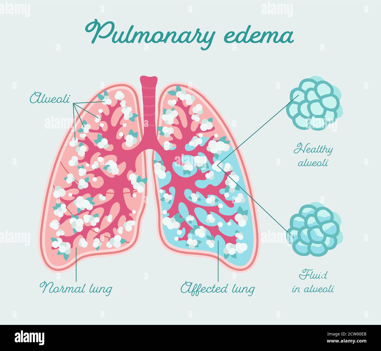 Pulmonary edema, edema of lung. Fluid in alveoli - vector anatomical scheme. Comparison healthy and fill of liquid lungs Stock Vector