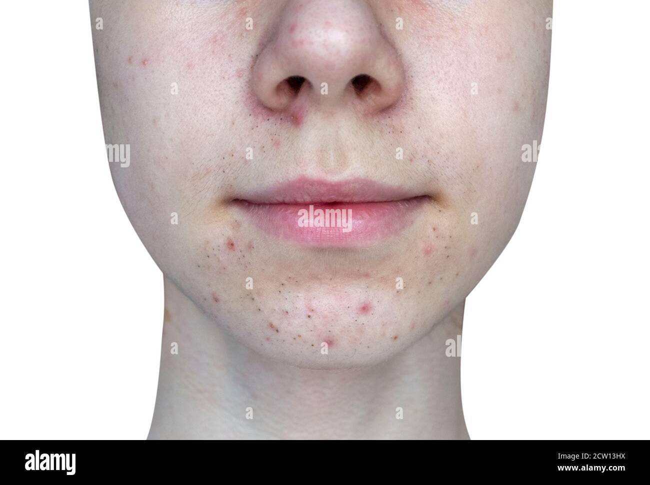 Teen face with skin acne isolated on white background Stock Photo