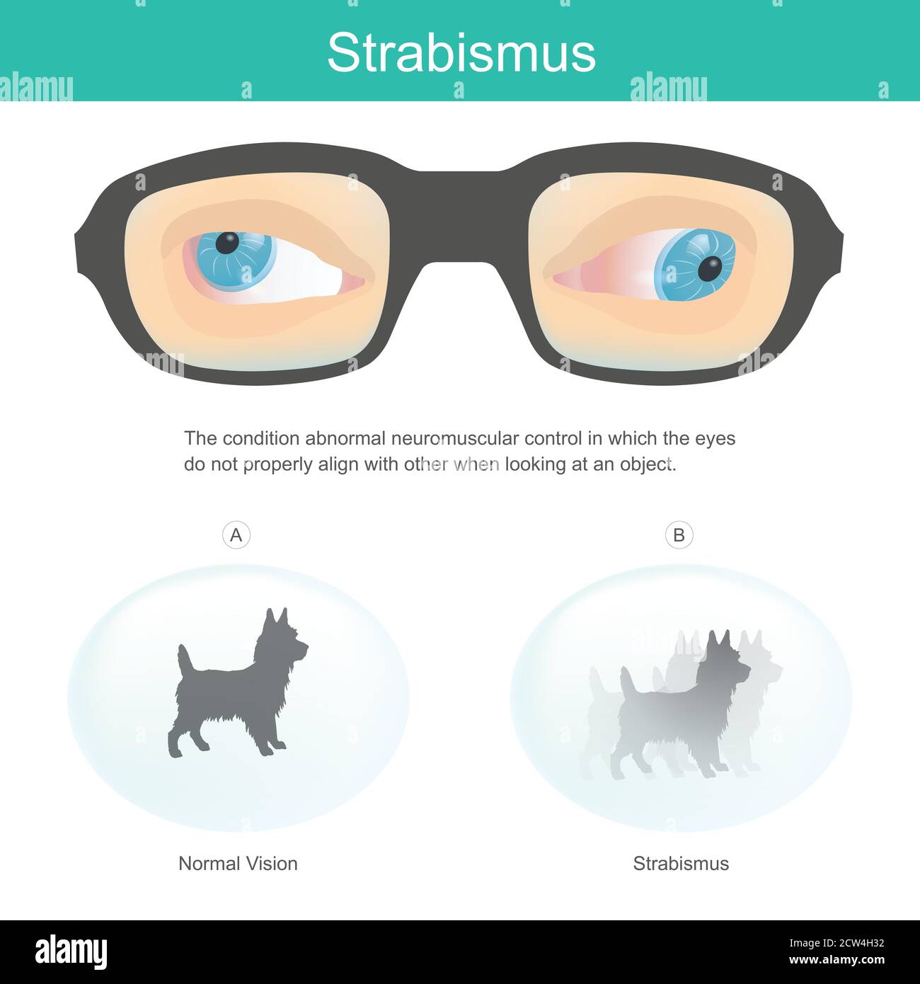 Strabismus. Meaning the condition abnormal neuromuscular control in which the eyes do not properly align with other when looking at an object. Stock Vector
