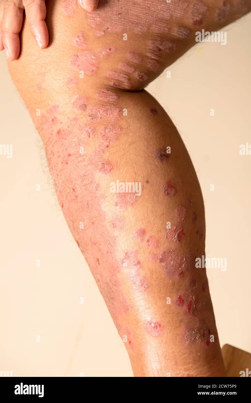 Diseases caused by abnormalities of the lymph. Psoriasis is a skin disease. Stock Photo