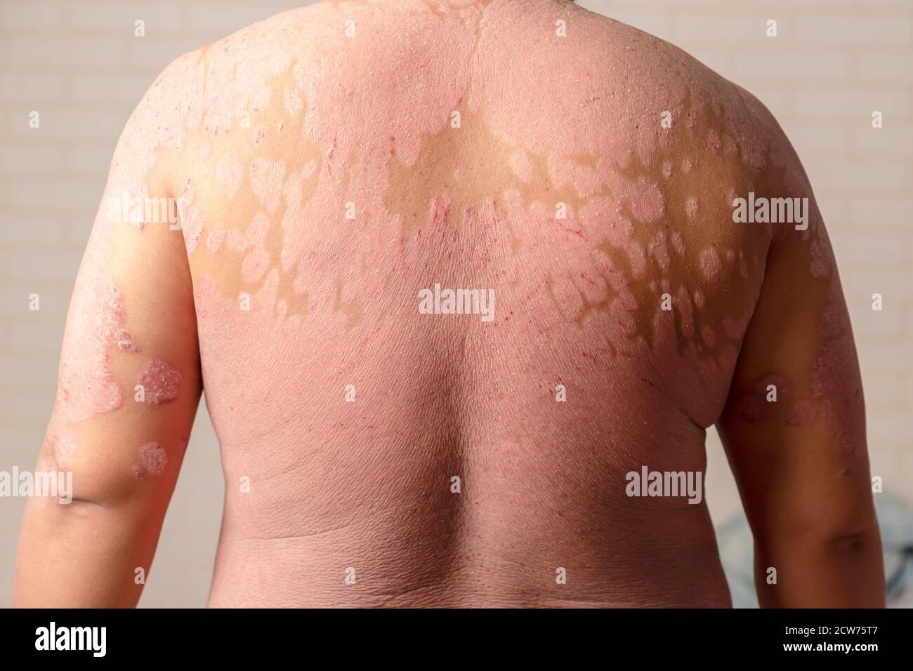Diseases caused by abnormalities of the lymph. Psoriasis is a skin disease. Stock Photo