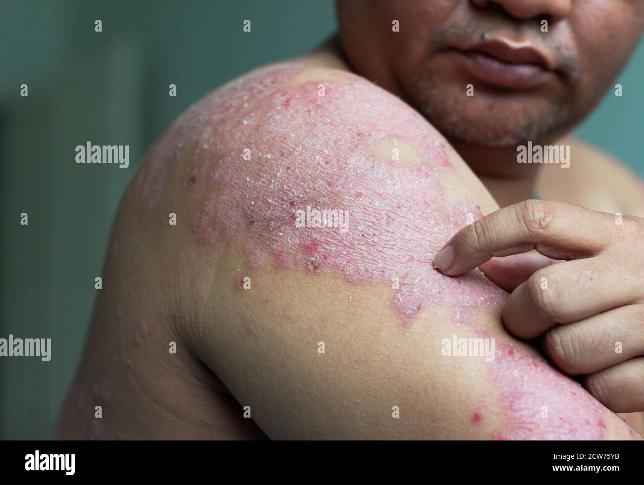 Men use their hands to scratch the wound in their arms. Diseases caused by abnormalities of the lymph. Psoriasis is a skin disease. Select focus shall Stock Photo