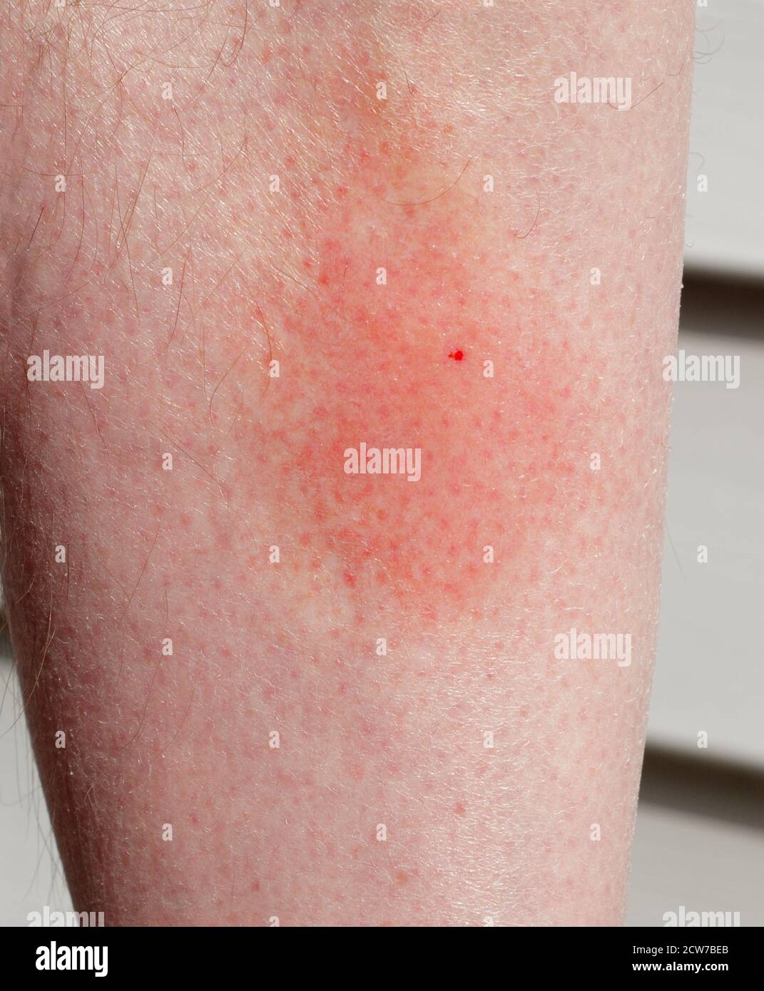 bee sting infection bee sting infection