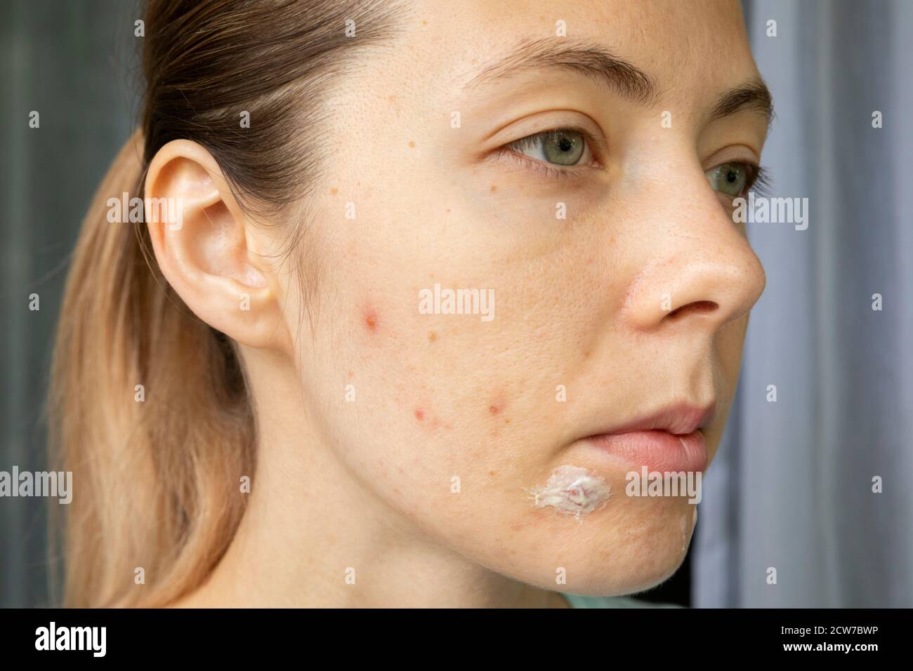 Young woman has skin problems. A girl applies a healing cream to acne