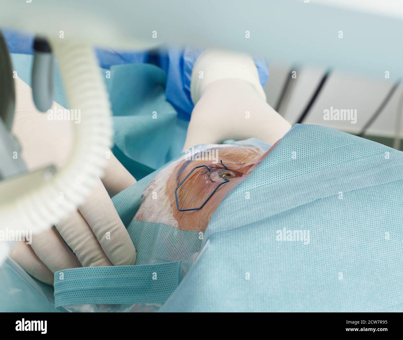 Date Witheye Open Woman with eye open in hospital Stock Photo - Alamy