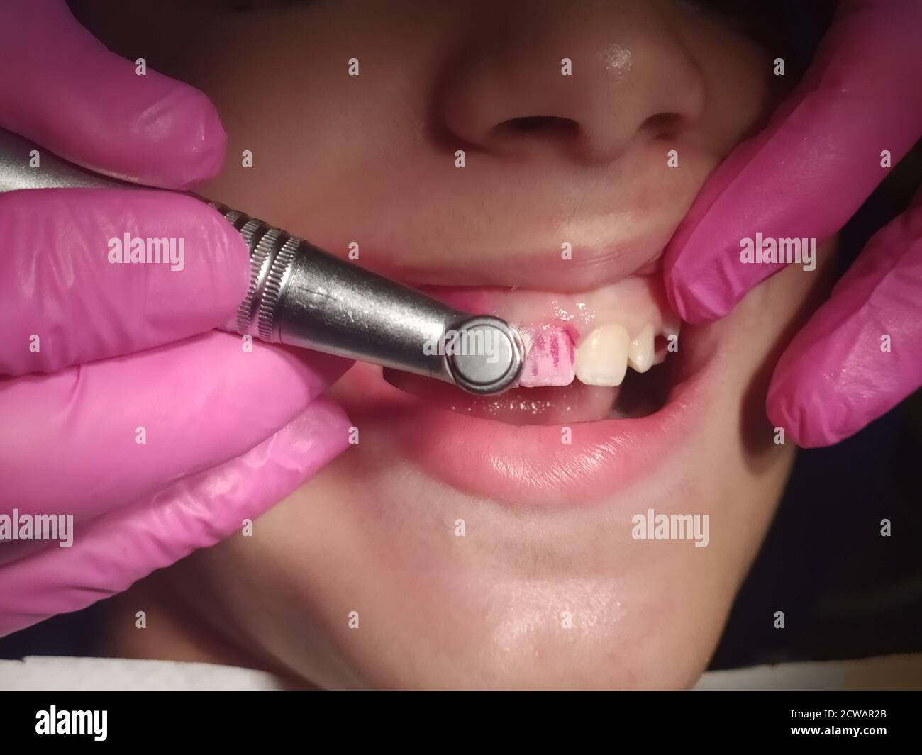 A young female patient being treated by a dental hygienist teeth being