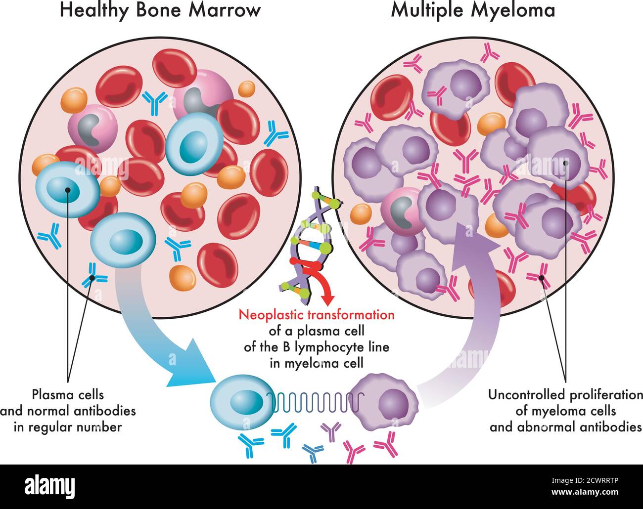 Medical illustration shows the transformation of plasma cells in healthy bone marrow into myeloma cells in multiple myeloma, due to DNA damage. Stock Vector