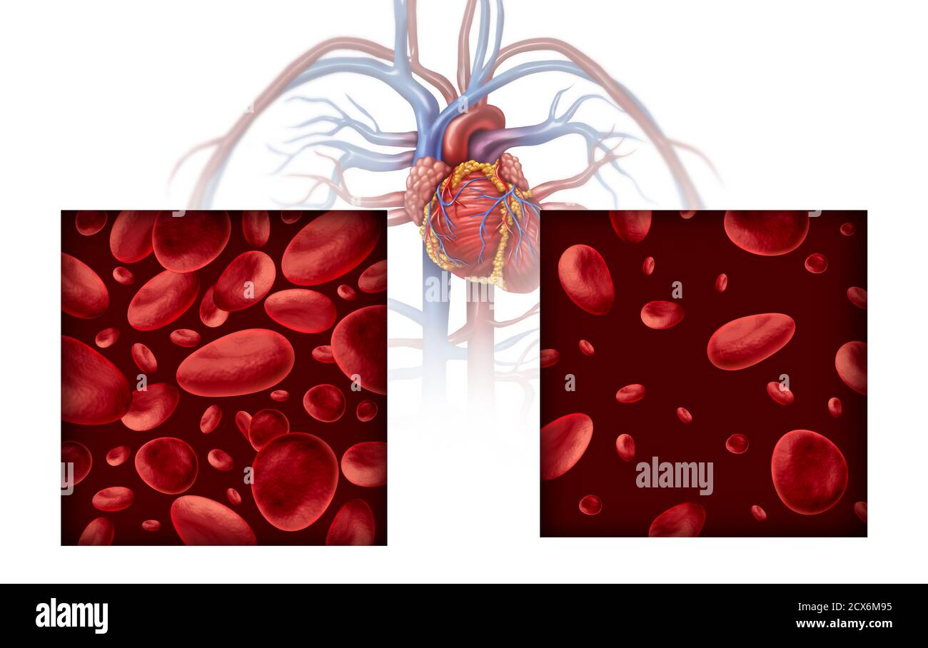 Anemia and anaemia medical diagram concept as normal and abnormal blood cell count and human circulation in an artery or vein as a 3D illustration. Stock Photo