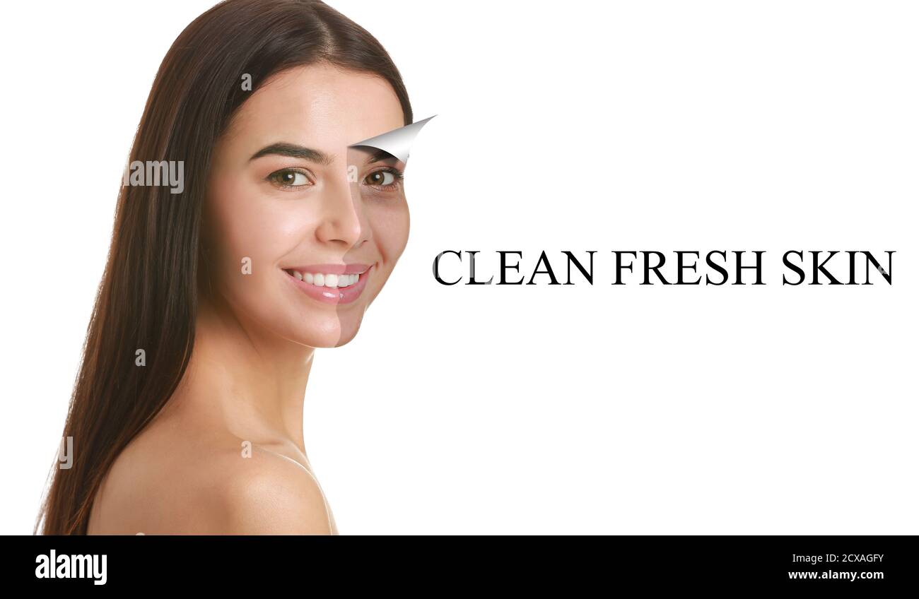 Young woman before and after facial cleansing procedure on white background Stock Photo Alamy