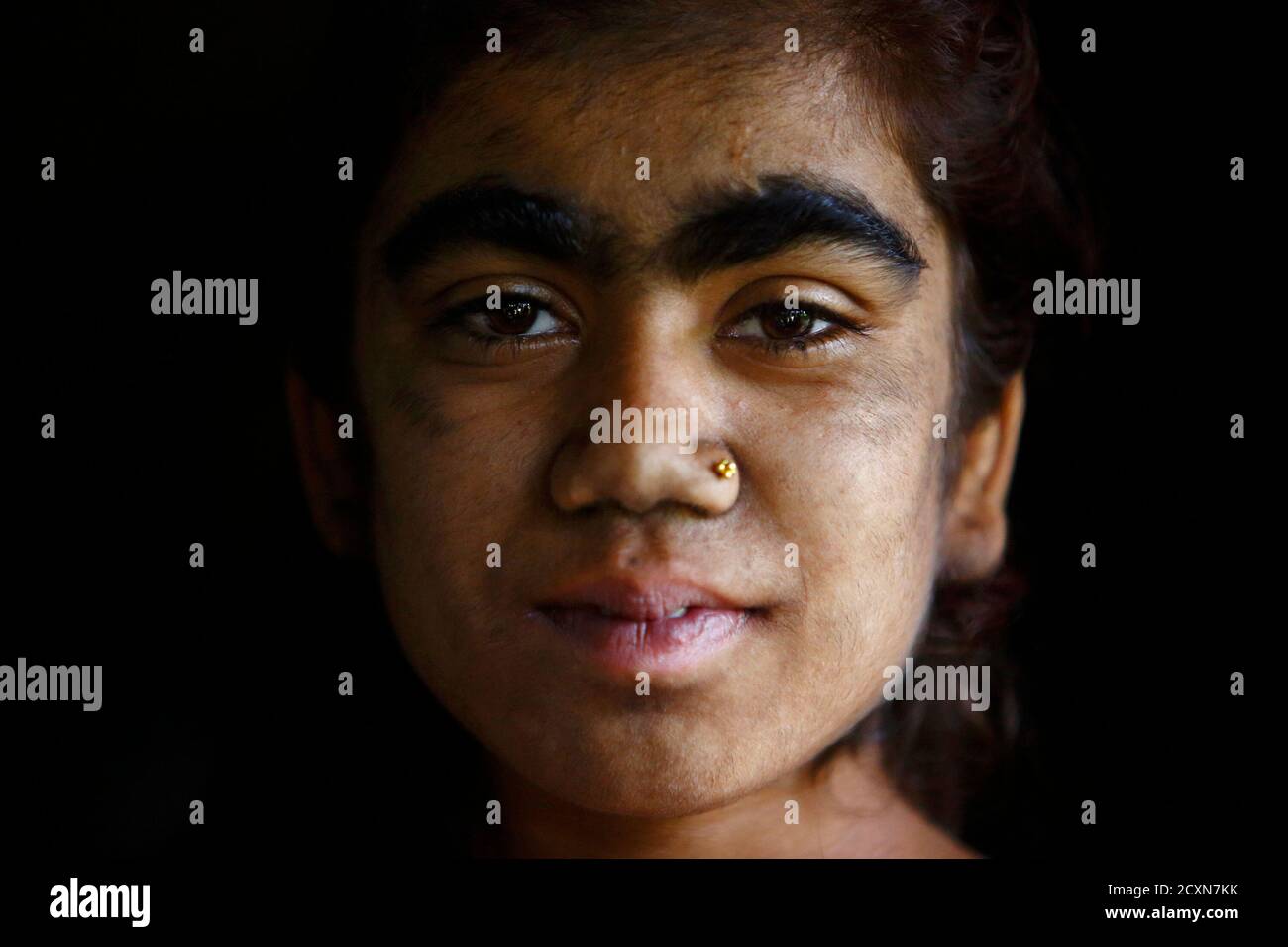 Werewolf syndrome hi-res stock photography and images - Alamy