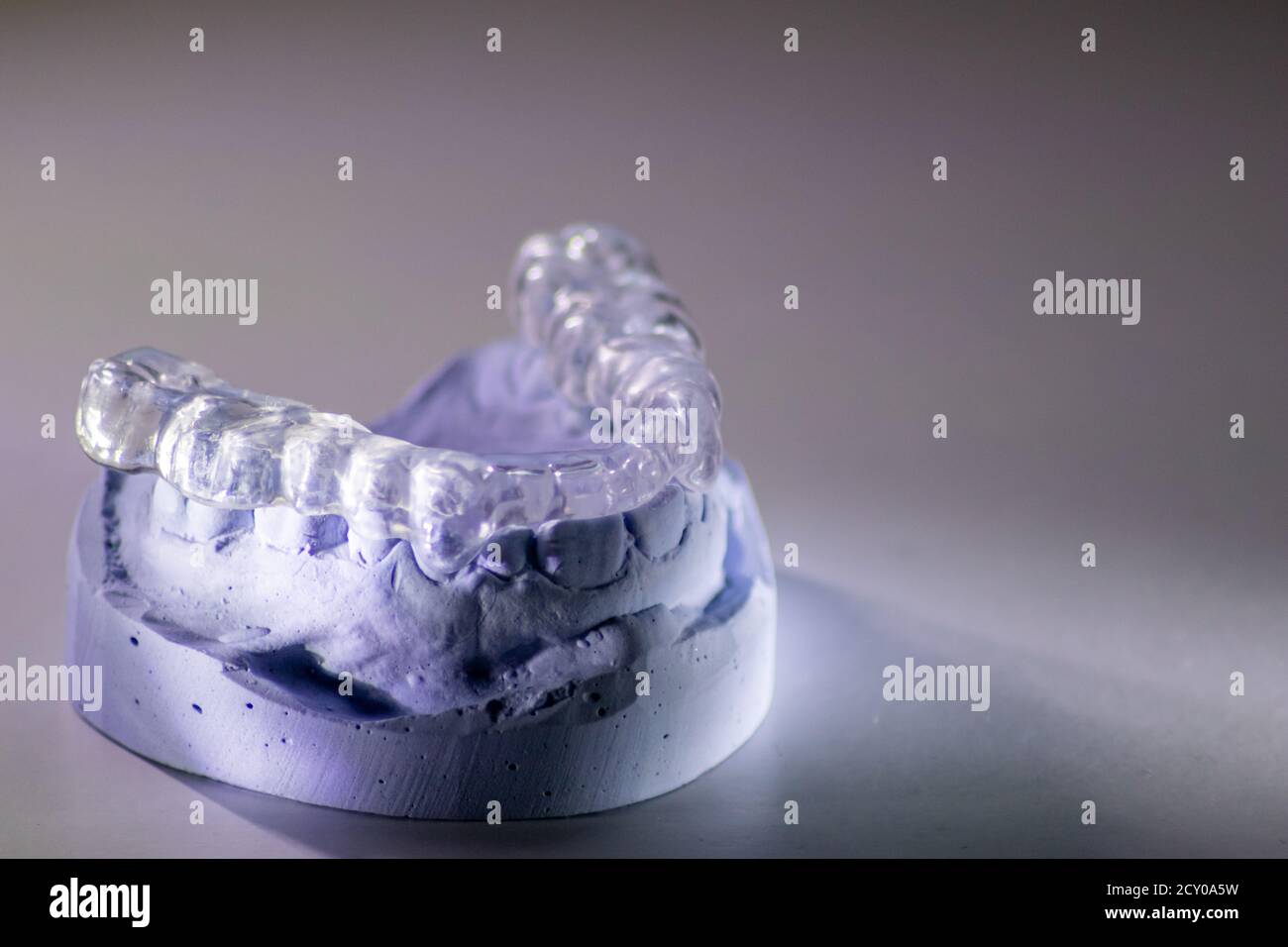 Dental splint against bruxism and grinding teeth with teeth imprint and