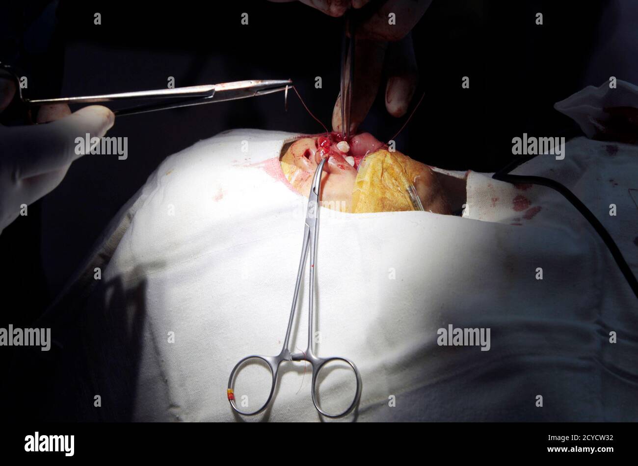 A Filipino Doctor Performs Cleft Lip Surgery On A 1 1 2 Year Old Girl Inside