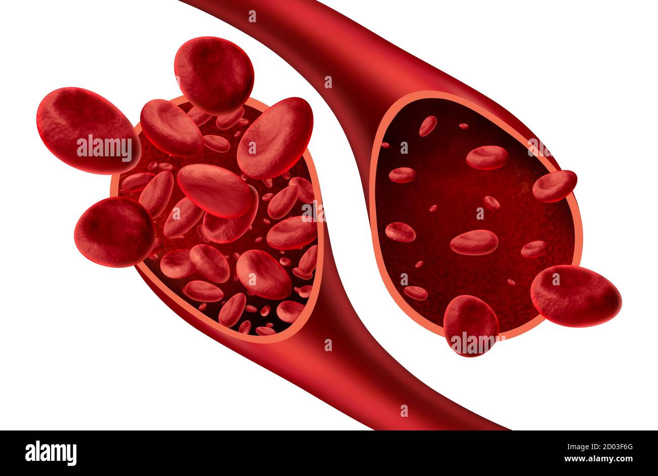 Anemia and anaemia medical diagram concept as normal and abnormal blood cell count and human circulation in an artery or vein. Stock Photo