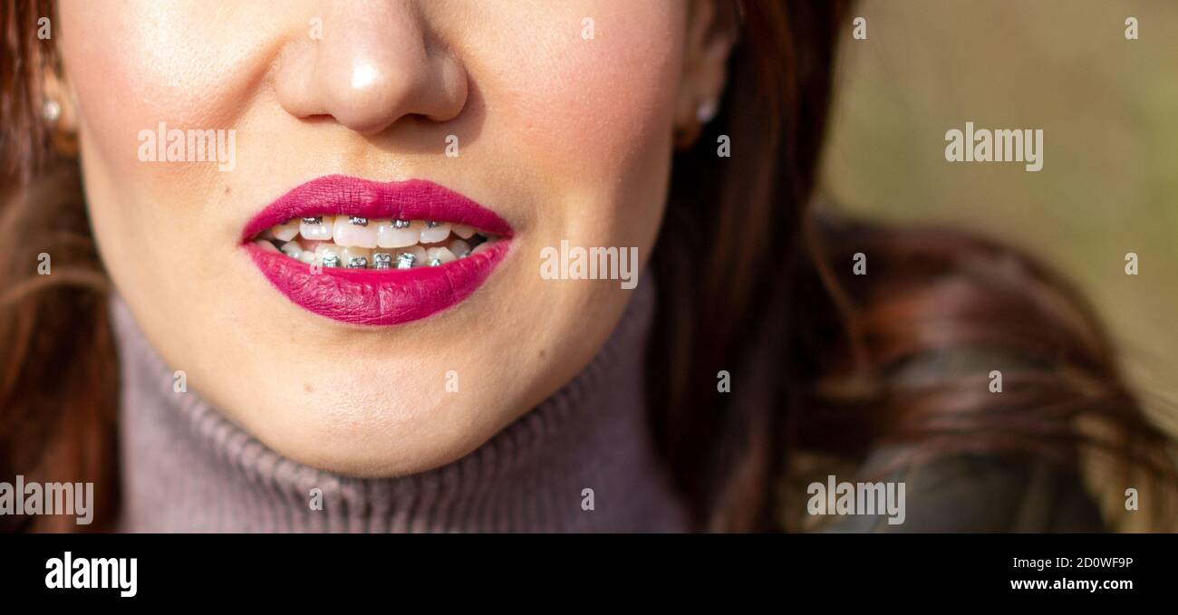 The brace system in the girl's smiling mouth, closeup of red lips