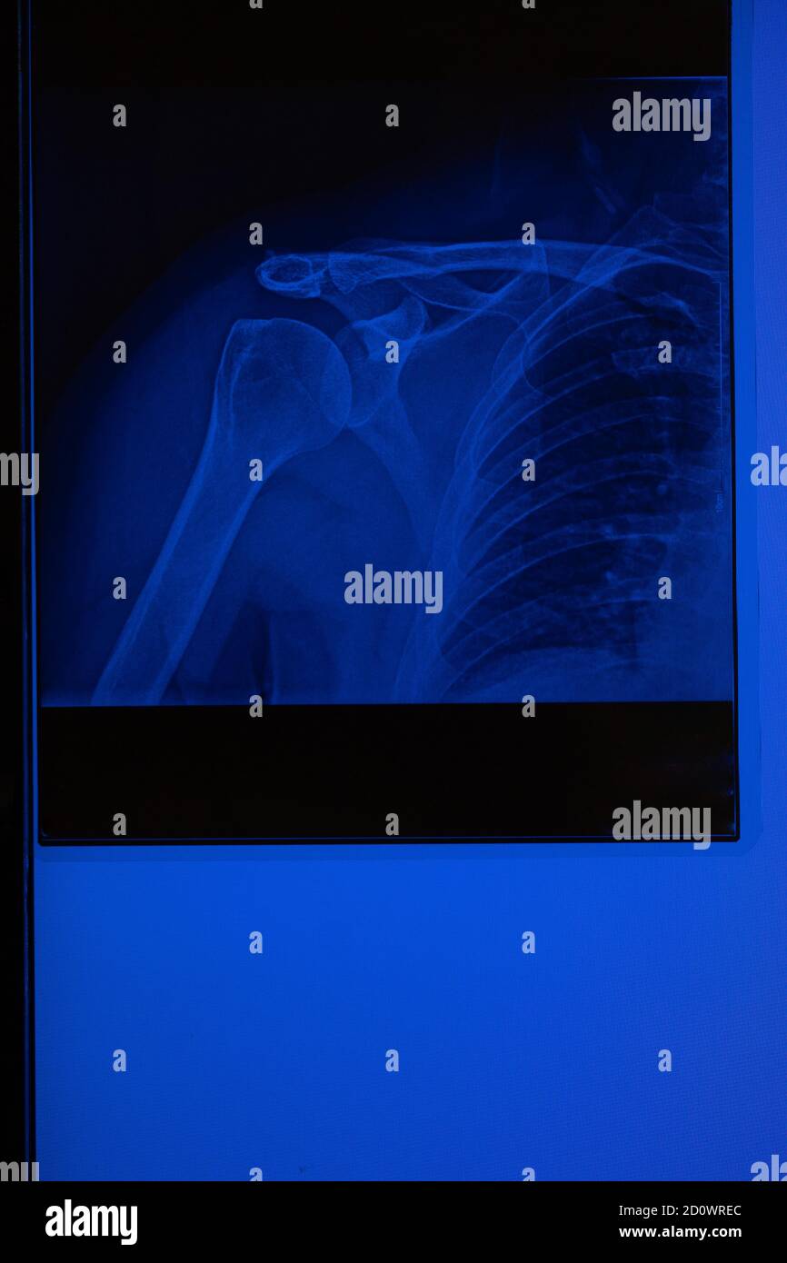 doctor's xray of the right shoulder Stock Photo Alamy