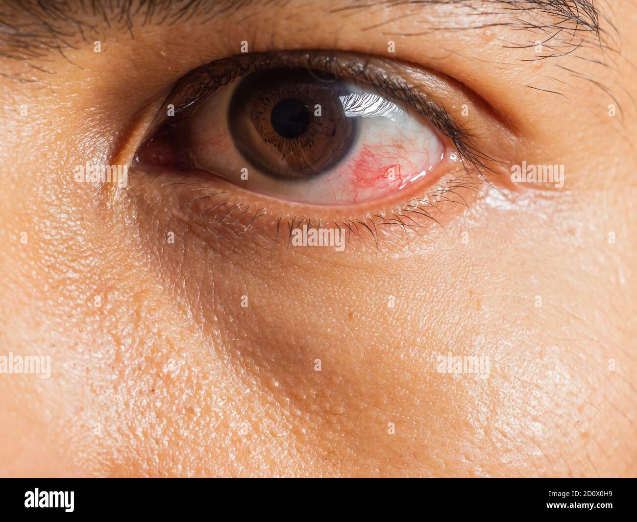 Infection irritated hires stock photography and images Alamy