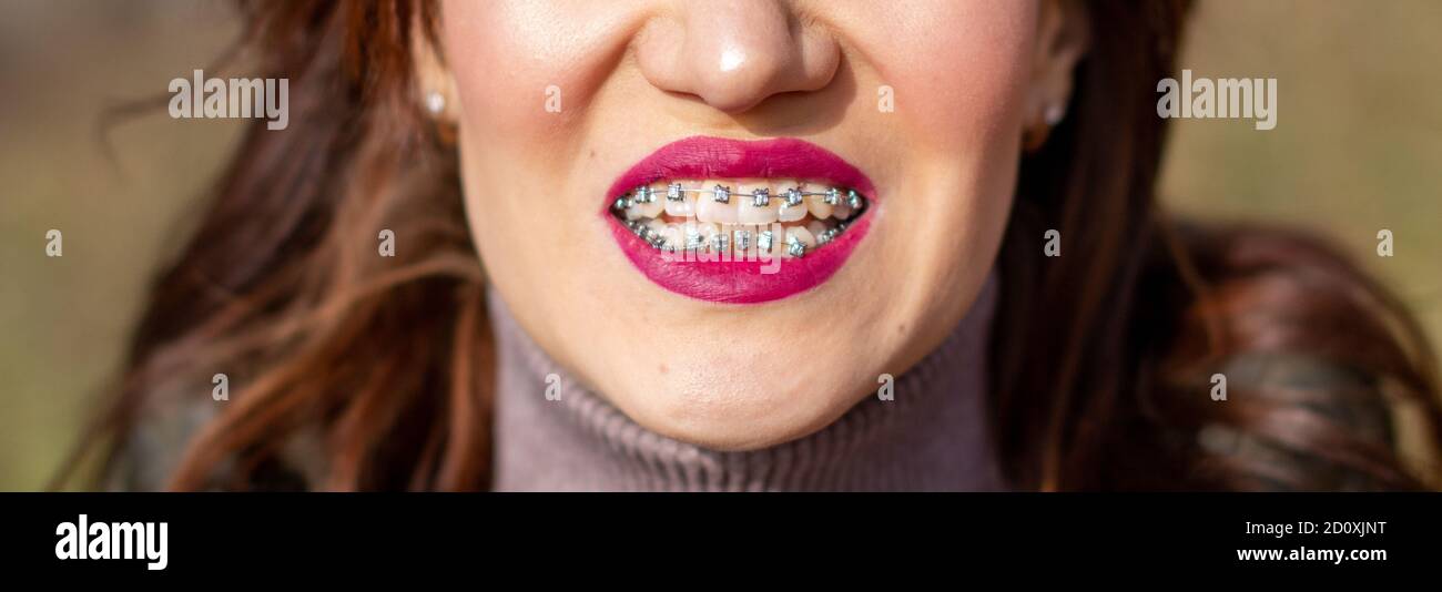 The brace system in the girl's smiling mouth, closeup of red lips