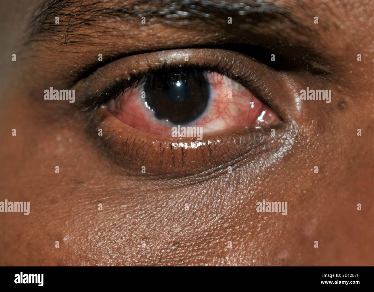 Red eyes. Indian guy. Close up of annoyed red eyes of male affected by conjunctivitis or after flu, cold or allergy. Disease and treatment. Stock Photo