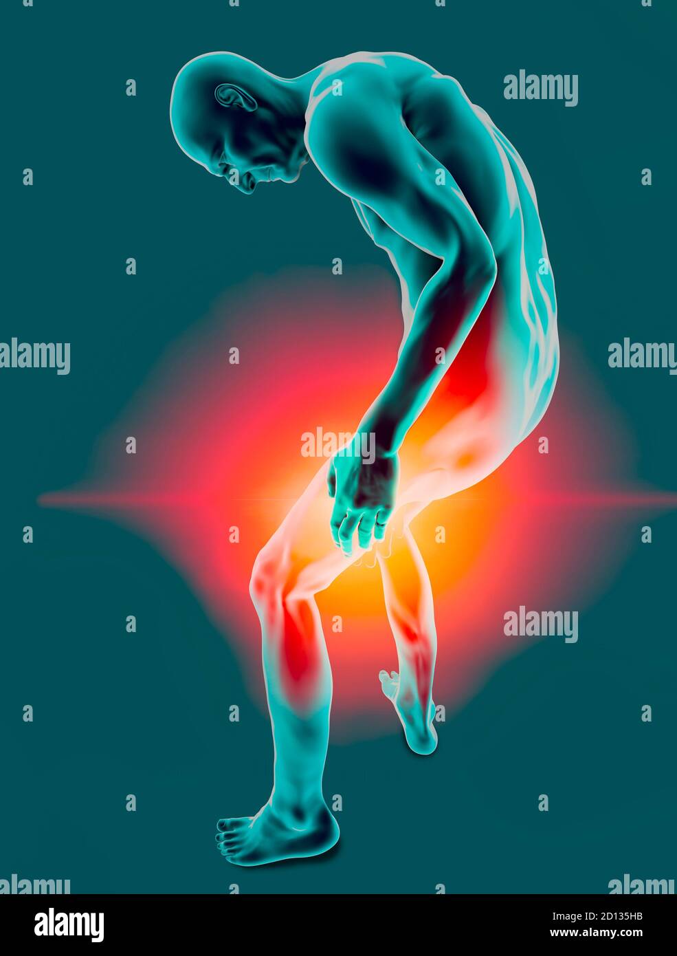 Fracture femur, elderly person. Brittle bones and muscle aches
