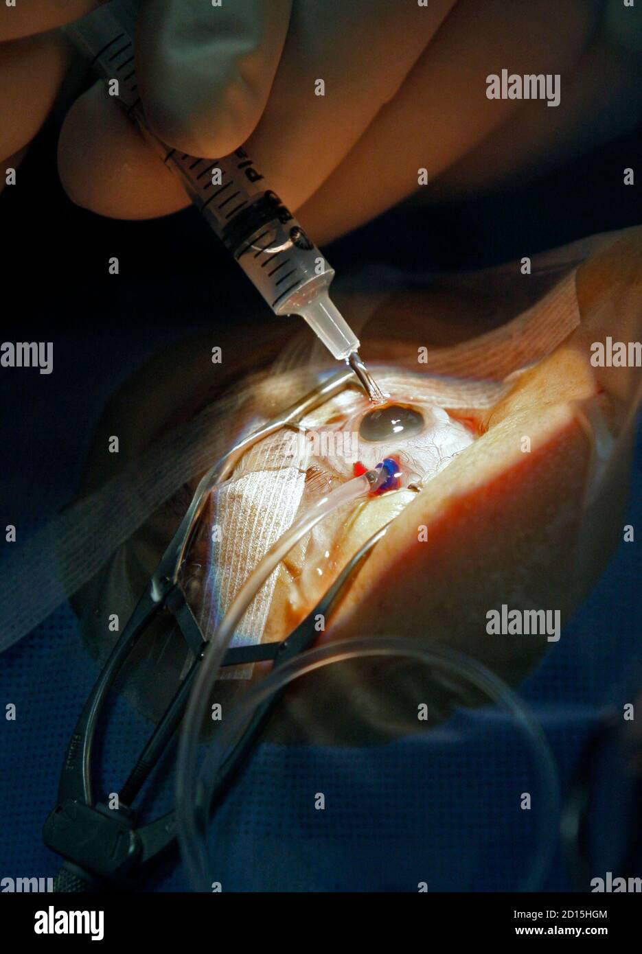 anesthesia for retina detachment surgery elderly anesthesia for retina detachment surgery elderly