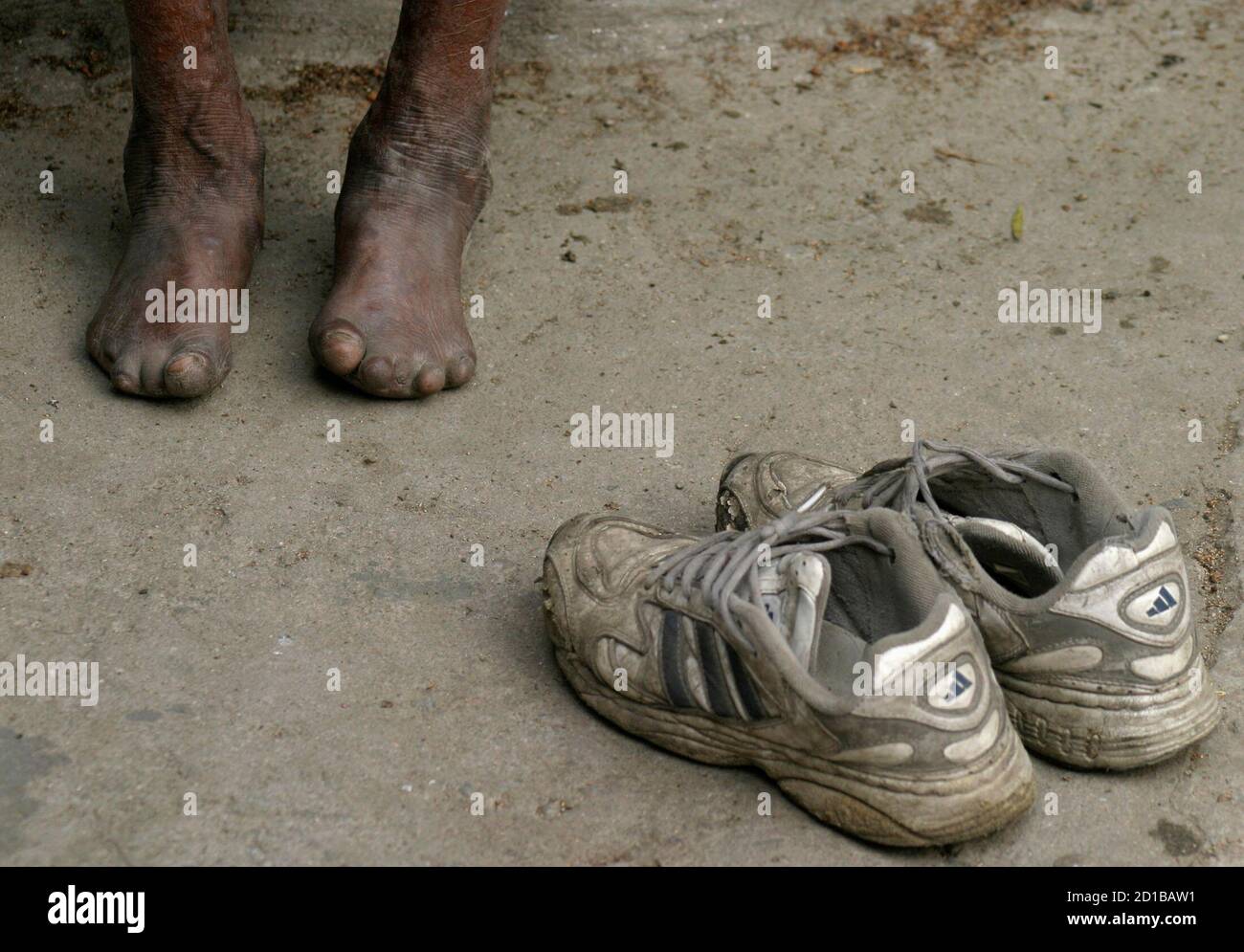 Indian leper hi-res stock photography and images - Alamy