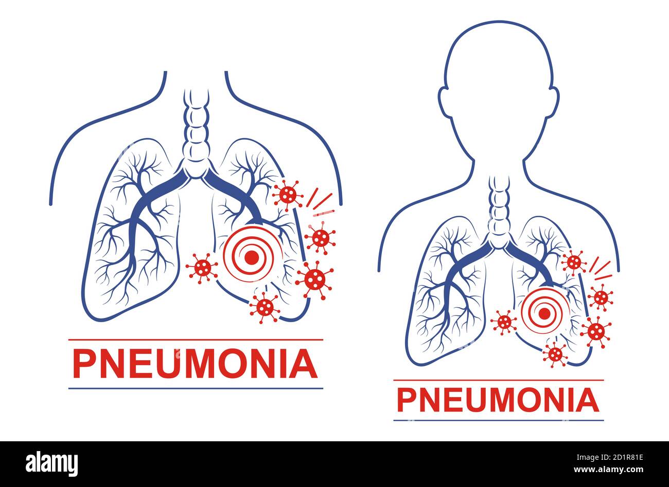 Pneumonia disease vector icon set. Human lungs and trachea anatomy. Treating for pneumonia. Treatment for coronavirus attack of respiratory system Stock Vector